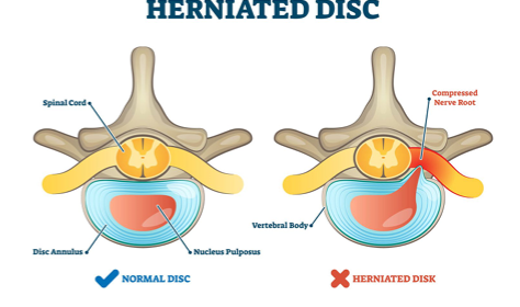 <p>inner disc bulges past outer disc </p><ul><li><p>hereditary = collagen </p></li><li><p>congenital = spinal deformity </p></li><li><p>increased age = dehydration and instability</p></li><li><p>trauma or repetitive strain</p></li><li><p>poor posture</p></li></ul><p></p>