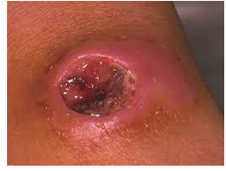 <p>commonly found in soil</p><p>infection often seen in farm workers and those working with untreated leather and wool</p><p>infection depends on route of exposure i.e. wound, inhaled or gastrointestinal</p><p>anthrax toxin: 3 components - protective antigen (PA), edema factor (EF), lethal factor (LF). latter two components have enzymatic activity interfering with cAMP levels effecting water homeostasis</p><p>can be treated with antibiotics (oral doxycycline or ciprofloxacin) and antitoxin to neutralize toxin</p><p>vaccine available</p>