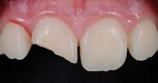 <p>Interproximal surfaces</p><p>of anterior teeth with Incisal</p><p>edge involevement</p>