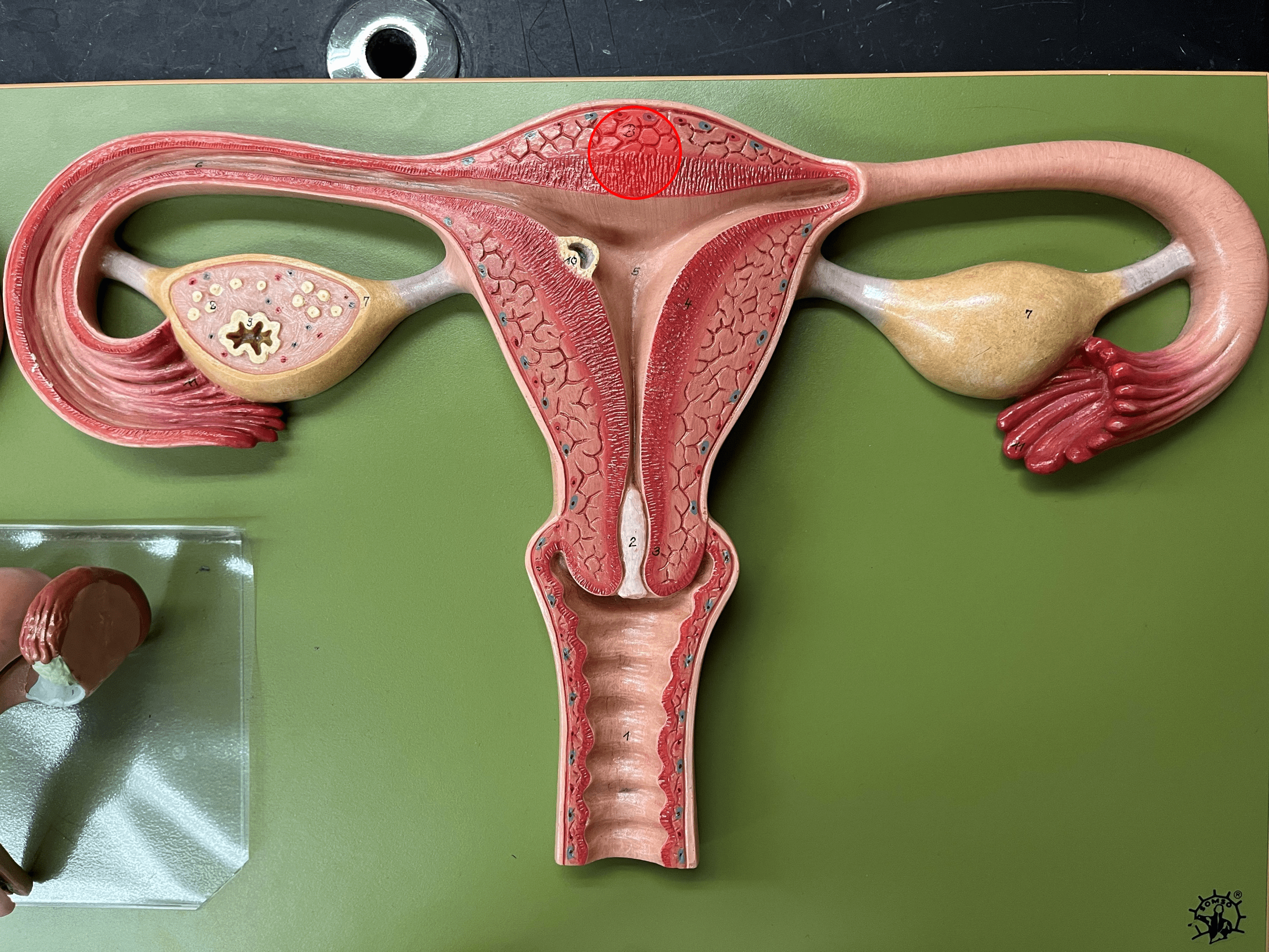 • A region of the uterus.

• The superior dome of the uterus.