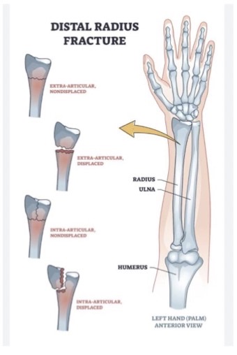 <p>acute injury</p><p>*surgeons work a lot with these</p><p>-non- displaced are more common (bone themselves dont come apart and move)</p><p>-displaced- see notable deformity bc seperation btn bones</p><p>intra articular- see crack going through the bone- more risk of displacement and more peices that need to heal</p>