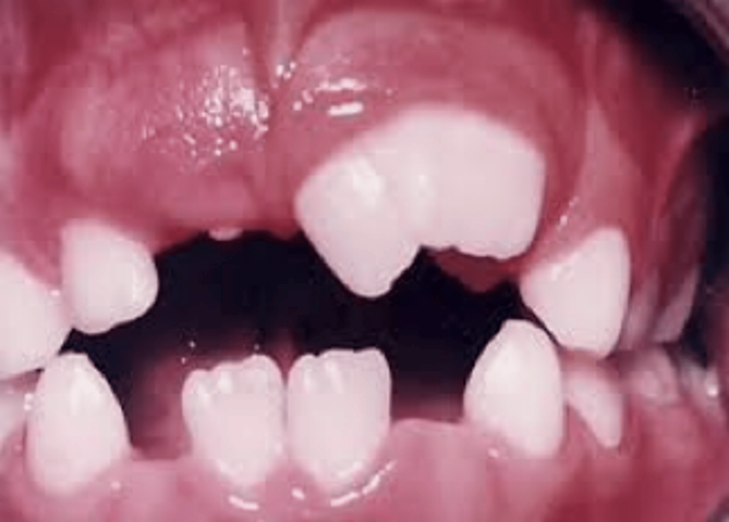 <p>developmental disturbance with single tooth germ trying to divide forming large single-rooted tooth</p>