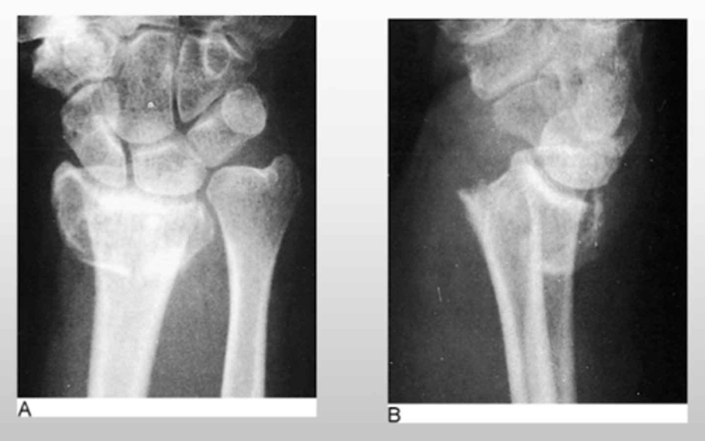 <p>colle's fracture</p><p>- wrist will have a dorsal angulation</p>