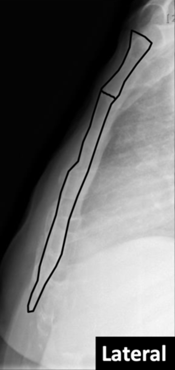 <p>The lateral view is preferred for studying the sternum because it allows for the appreciation of its shape and alignment.</p>