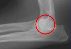 <p>This is fragmentation of the medial coronoid process</p>