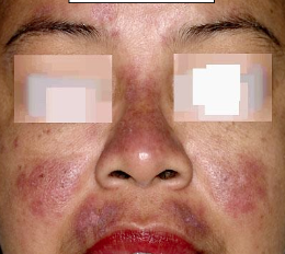 <p>What is a common feature of Systemic Lupus Erythematosus?</p>