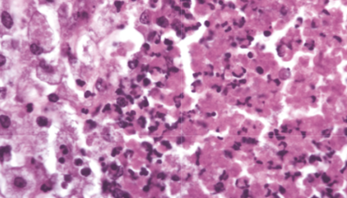 <p>What type of necrosis is being shown in this photo?</p>