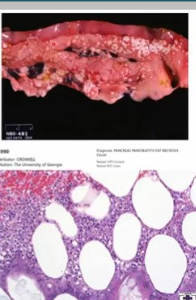 <p>What type of necrosis is this? 4 possible causes. Describe the gross and histological features. </p>