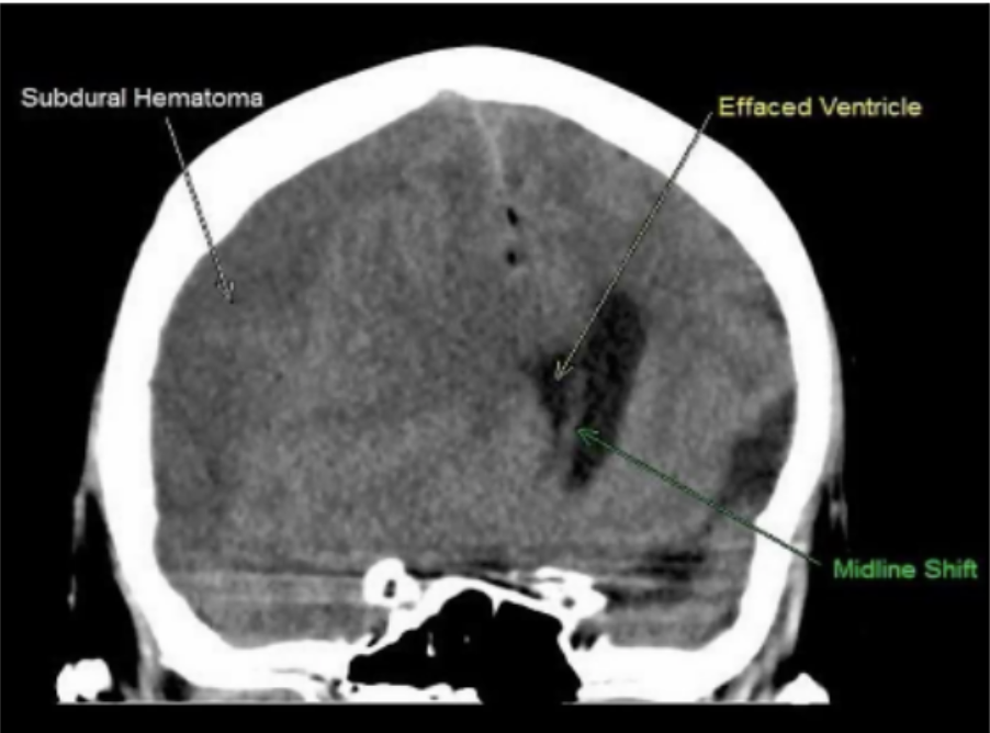 <p>Subdural Hematomas</p>