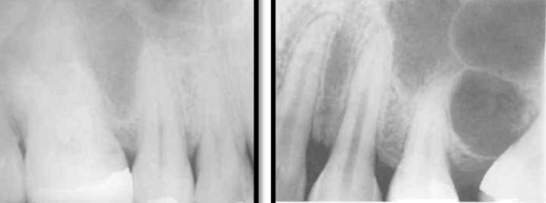<p><span>may extend from the </span><span style="color: red;"><span>premolars to the tuberosity</span></span></p><p><span>the apices of the </span><span style="color: red;"><span>2nd premolar and 1st molar</span></span><span> lie close to</span></p><p><span>the floor of this may dip between the roots &amp; may be oculated giving the appearance of a cyst</span></p>
