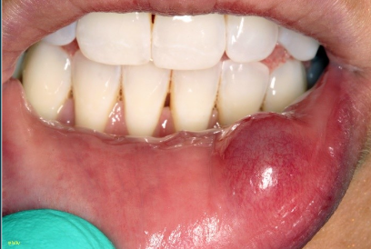 <p>What is a mucocele?</p>