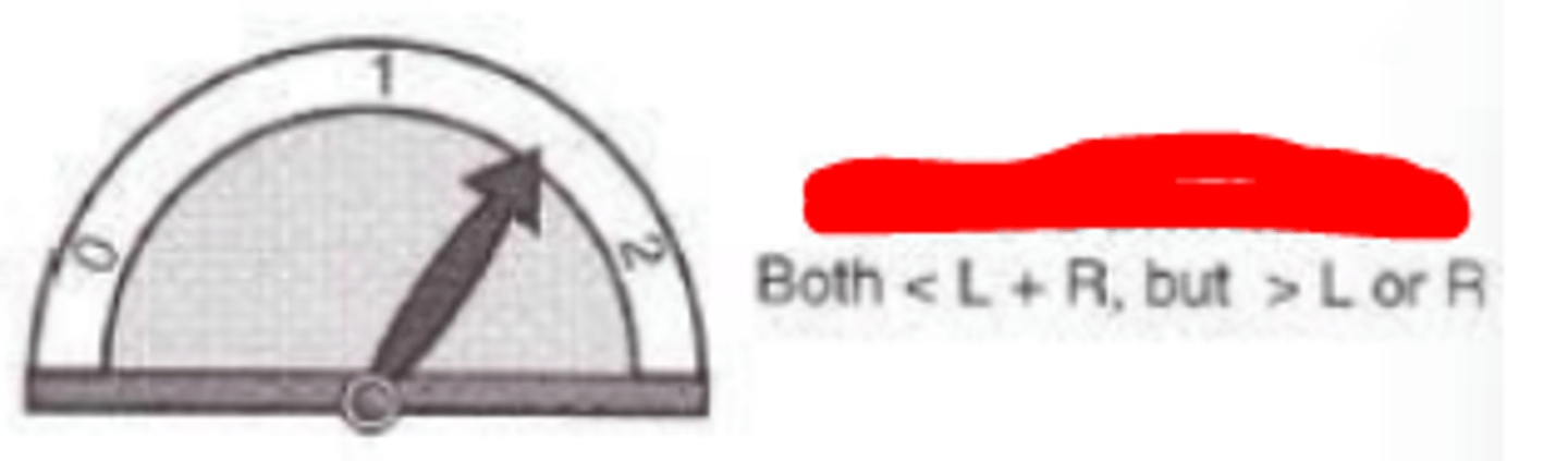 <p>degree of binocular summation where there is an incomplete summation of each eye's visual performance to binocular performance. The binocular view is less than the sum of the two eyes, but is still greater than using a single eye individually.</p>