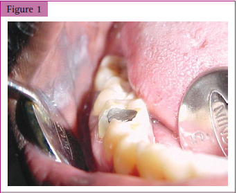 <p>__________ on the left buccal mucosa in close vicinity to the restoration. The lesion also shows faint white keratotic striae indicative of a lichenoid reaction.</p>