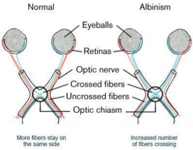 <ul><li><p>more fibers of the optic nerve crosses than normal</p></li><li><p>affects depth perception</p></li></ul><p></p>