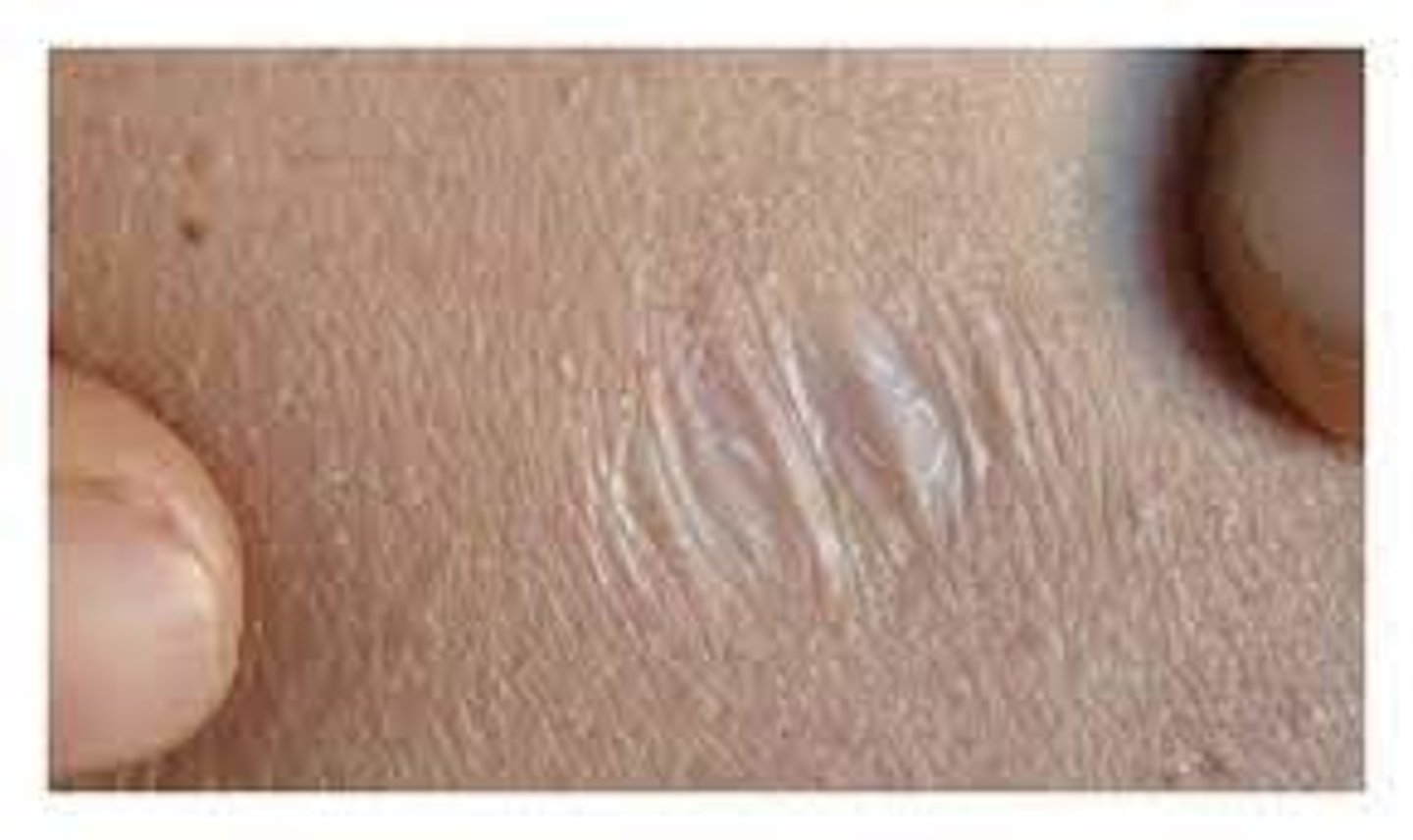 <p>Scar resulting in a skin depression because of lost tissue</p>