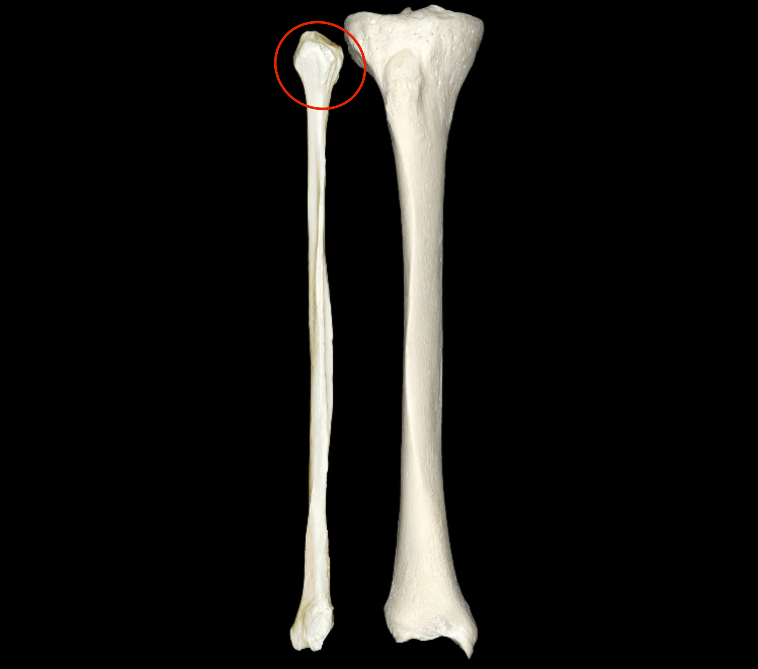 <p>constriction on proximal end of fibula </p>