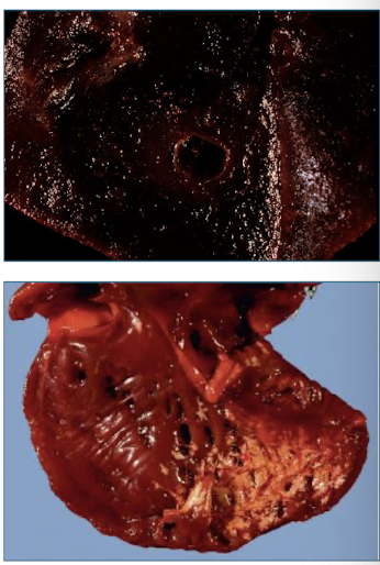 <ul><li><p>splenic congestion</p></li><li><p>pulmonary congestion & edema</p></li><li><p>discoloration of blood</p></li><li><p>coagulation of endocardium</p></li></ul><p></p>