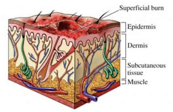 <ul><li><p>Superficial burns</p></li><li><p>Involves only the epidermis</p></li><li><p>Characterized by pain, redness and swelling</p></li></ul>