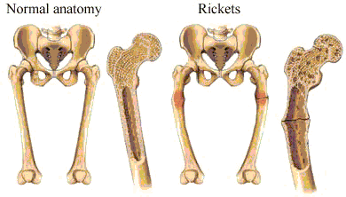 <p>A disease marked by softening of the bone caused by calcium and vitamin D deficiency.</p><p>The adult form of rickets.</p>