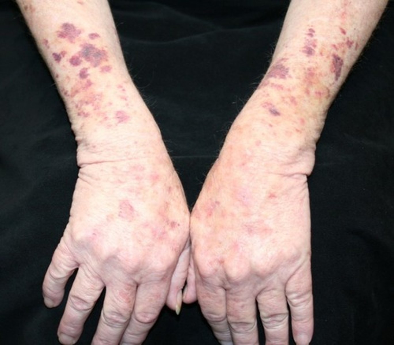 <p>larger area of hemorrhage that may be palpable. does not blanch. may indicate a coagulopathy. Large areas may be called ecchymoses or, colloquially, bruises</p>