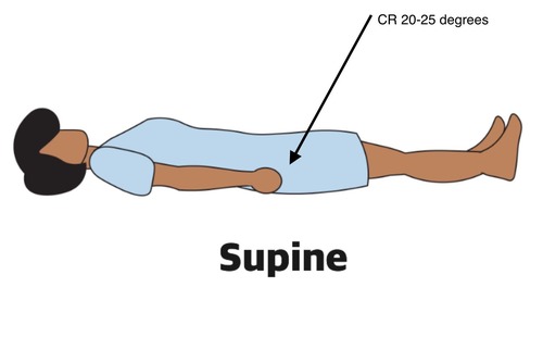 <p>perpendicular through the hip joint and at a cephalic angle of 20 to 25 degrees and an additional 1 inch more inferior</p>