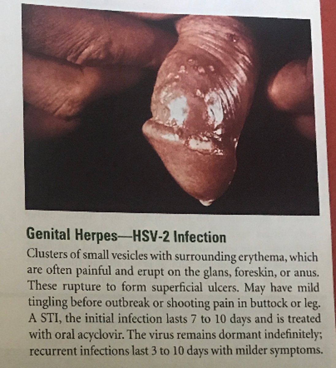 <p>C</p><p>Genital herpes, or herpes simplex virus 2 (HSV-2), infections are indicated with clusters of small vesicles with surrounding erythema, which are often painful and erupt on the glans or foreskin. (See Table 24-4 for the descriptions of the other options.)</p>