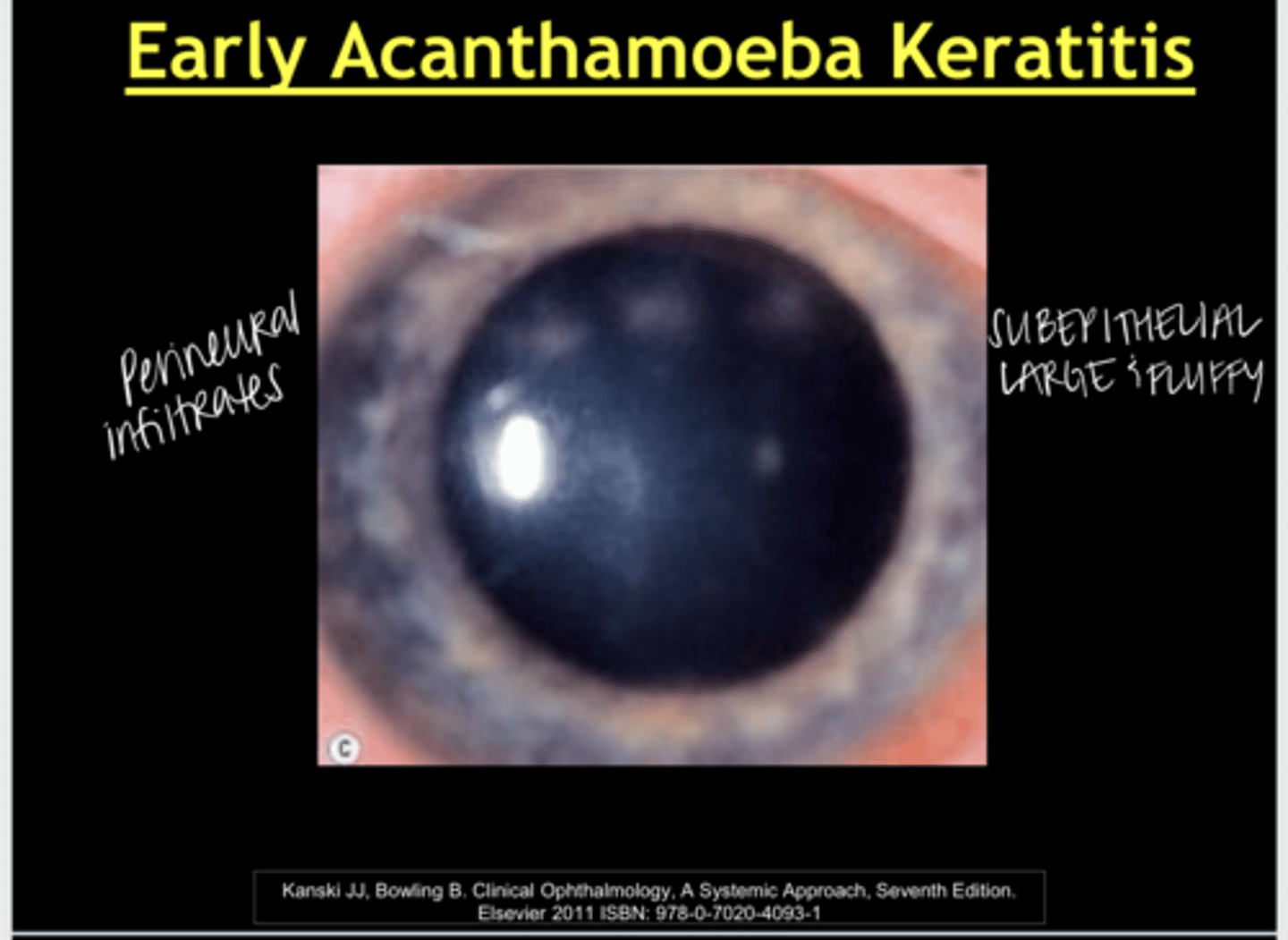 <p>Acanthamoeba Keratitis -- Ring Infiltrate (Pic)</p>