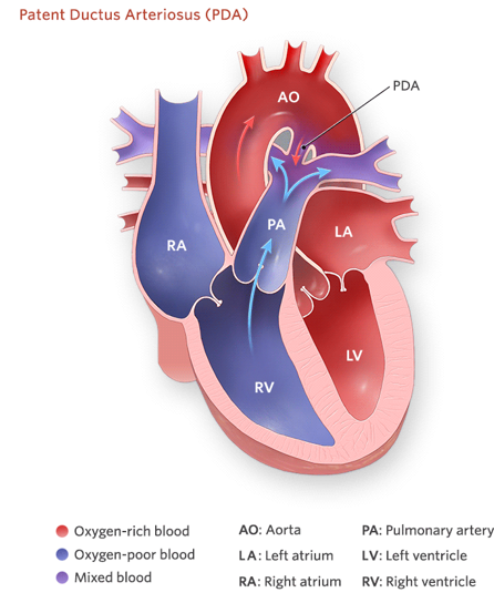 <p><strong><u>Increased</u> Pulmonary Blood Flow</strong></p><ul><li><p class="">Second most common congenital heart defect!</p></li><li><p class=""><strong><em>Persistent connection between the aorta and pulmonary artery</em></strong>.</p></li><li><p class="">More common in <u>premature infants</u> and those <u>born in high-altitude areas</u>.</p></li><li><p class="">Can occur to accommodate right to left shunting diseases.</p></li><li><p class="">If small, may be asymptomatic.</p></li><li><p class="">If larger, may exhibit signs of heart failure.</p></li></ul><p></p>