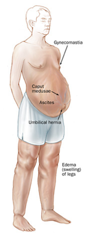 <p>A blood clot blocking flow through the liver might</p><p>cause_________</p>