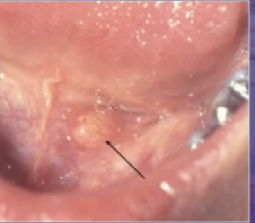 <p>which of the following is NOT in the ddx of a yellow lesion </p><p>lymphoepithelial cyst </p><p>lipoma </p><p>lymphoid hyperplasia </p><p>sialolith </p>