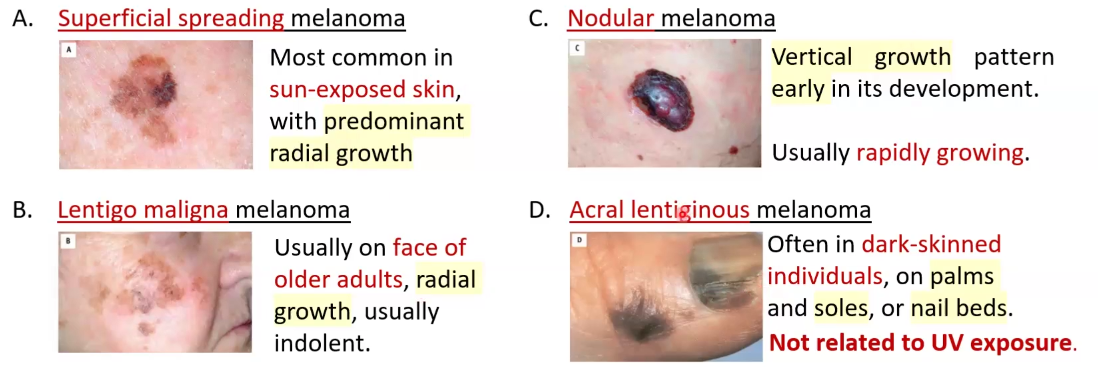 <ul><li><p>Malignant neoplasm of melanocytes</p></li><li><p>Strongly linked to mutations caused by exposure to UV radiation</p><ul><li><p>Leading cause of mortality in young adults</p></li></ul></li><li><p>Pathogenesis: caused by UV radiation damaging DNA of melanocytes; hereditary predisposition 5-10%</p><ul><li><p>Mutations in <strong>CDKN2A</strong> gene disrupt cell cycle oncogenes</p></li><li><p>Mutations in <strong>BRAF</strong> and <strong>NRAS</strong> genes activate <strong>MAPK</strong> pathway</p></li></ul></li><li><p>Morphology: variation in pigmentation, larger size &gt;mm, Irregular notched borders</p></li><li><p>Types of spread:</p><ul><li><p>Superficial</p></li><li><p>Lentigo: radial growth on face</p></li><li><p>Nodular: vertical growth and rapidly growing</p></li><li><p>Acral lentiginous: palms soles and nail beds get coloration in dark individuals; not related to UV exposure</p></li></ul></li><li><p><strong>Tumor markers: S-100 and HMB-45</strong> and use ABCDE guide</p></li></ul><p></p>