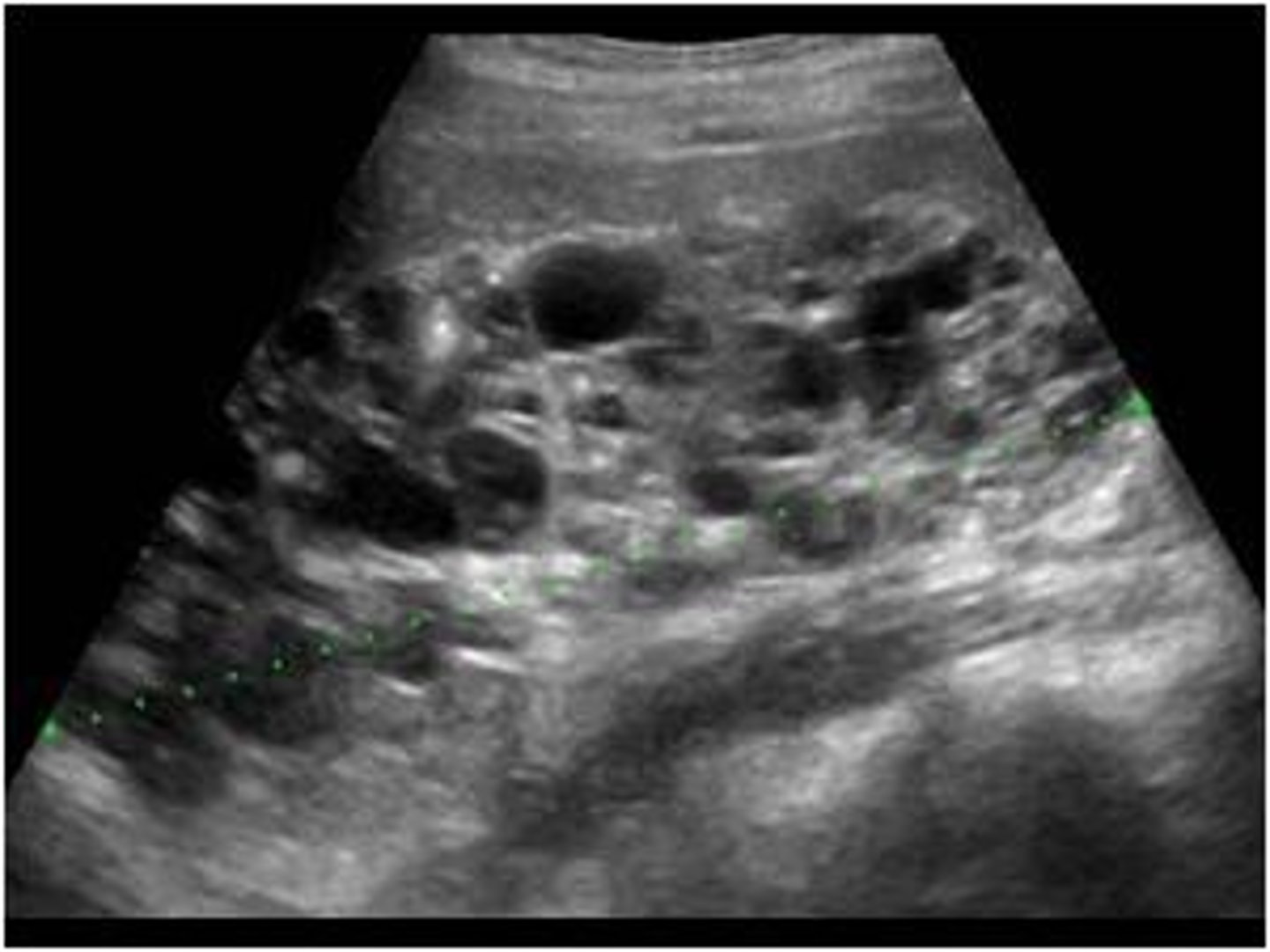 <p>Initial: renal US</p><p>Overall: MRI</p>