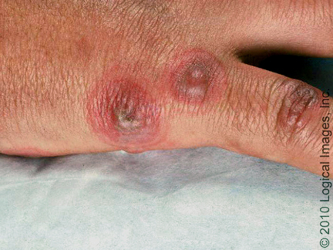 <p><strong>little/no mucous membrane involvement</strong>; vesicles but no bullae; eruption confined to face or extremities, <strong>classic target lesions</strong>; </p><p>rash starts on extensor surfaces of extremities and spreads centripetally</p><p>assoc. w/ HSV days prior </p>