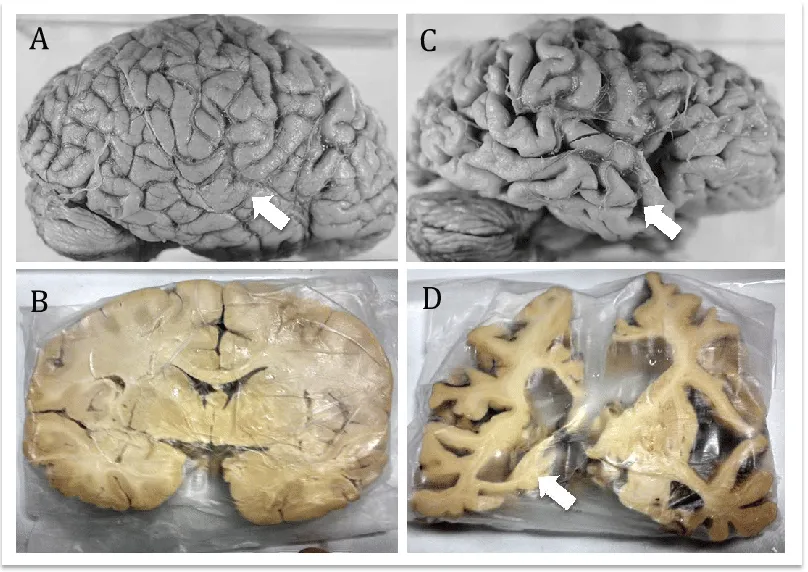 <p>Main symptoms of Alzheimer’s disease</p>