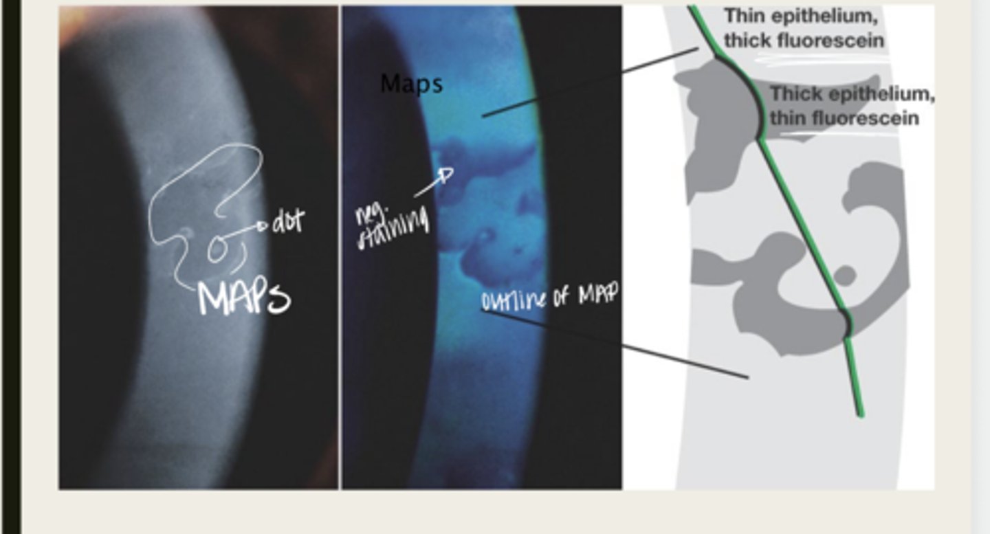 <p>What proportion of the population does Epithelial Basement Membrane Dystrophy affect?</p>