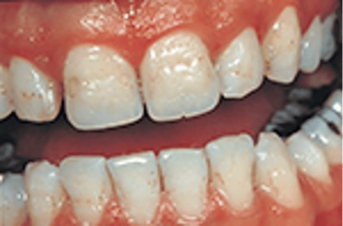 <p>incomplete or improper development of the enamel tissue, this picture shows the pitting on the labial surface</p>