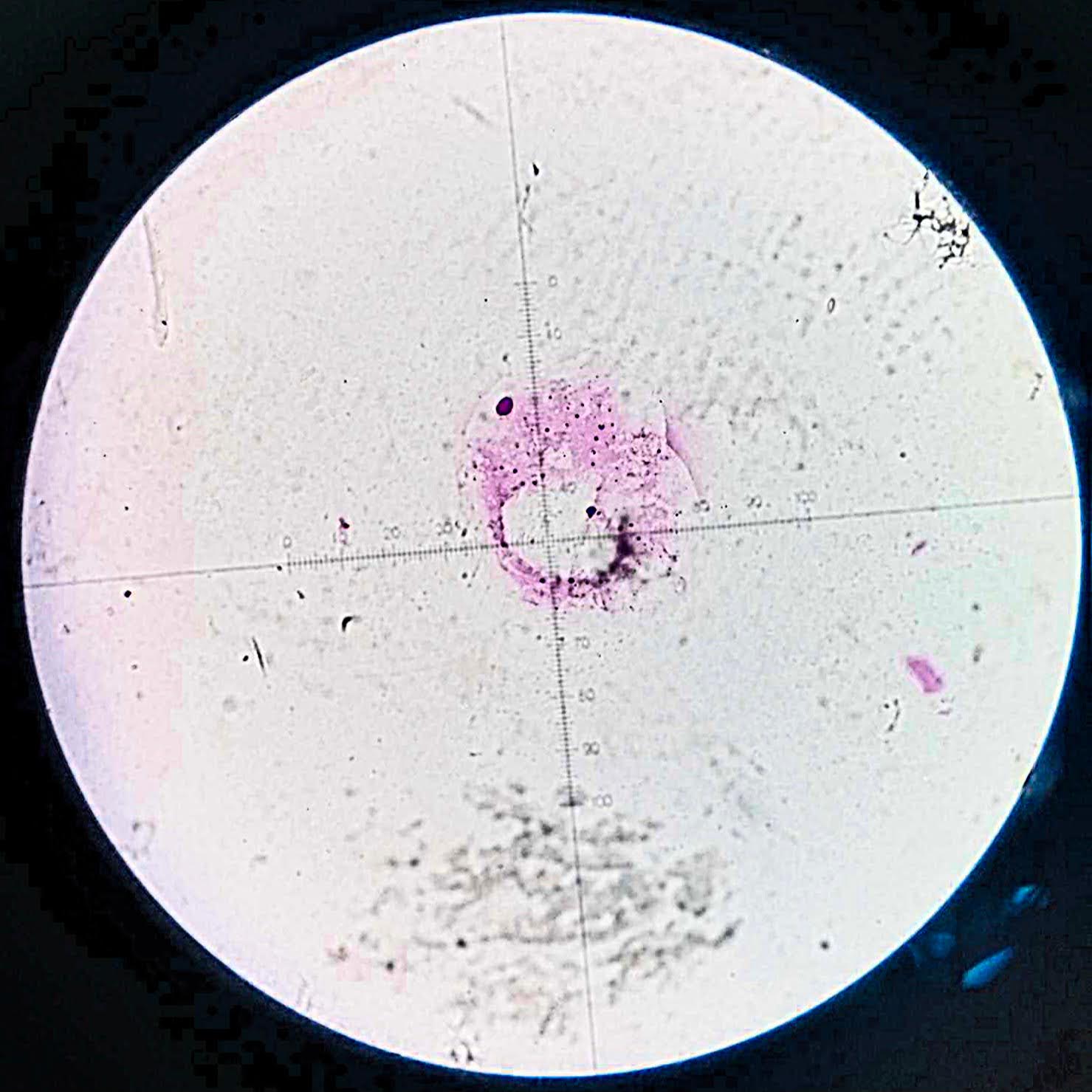 <p><em><mark data-color="#fecae0" style="background-color: #fecae0; color: inherit">Alcaligenes faecalis </mark></em></p><ul><li><p><span style="font-family: Times New Roman, serif">Rod (bacillus)</span></p></li><li><p>singles or in pairs </p></li><li><p>Pink</p></li><li><p>Gram negative </p></li><li><p><strong>trigger local infections, including peritonitis, meningitis, otitis media, appendicitis, and bloodstream infection</strong></p></li></ul><p></p>