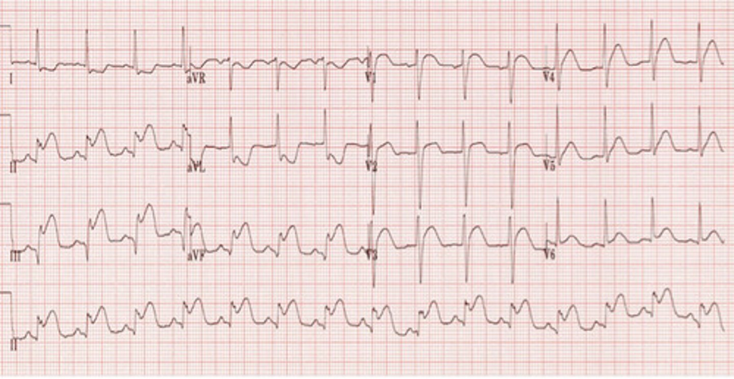 <p>Inferior STEMI</p>
