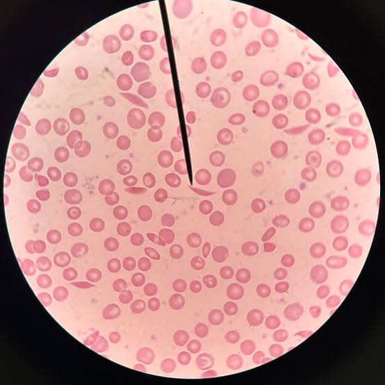 <p>Sickle cell</p>
