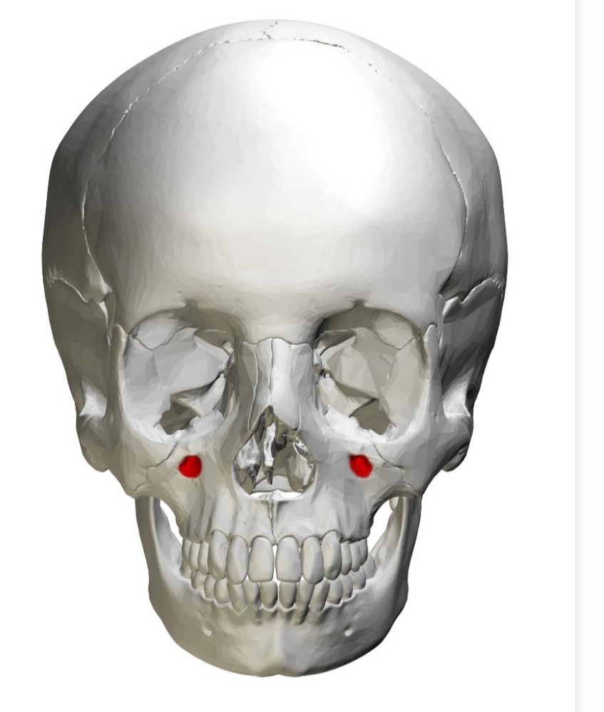 <ul><li><p>Opening in bone (slight depression)</p></li><li><p>Located bilaterally between eye (orbit) and canine/premolar root area</p></li><li><p>Infraorbital nerve infiltrates with anesthetic for maxillary anterior teeth</p></li></ul><p></p>