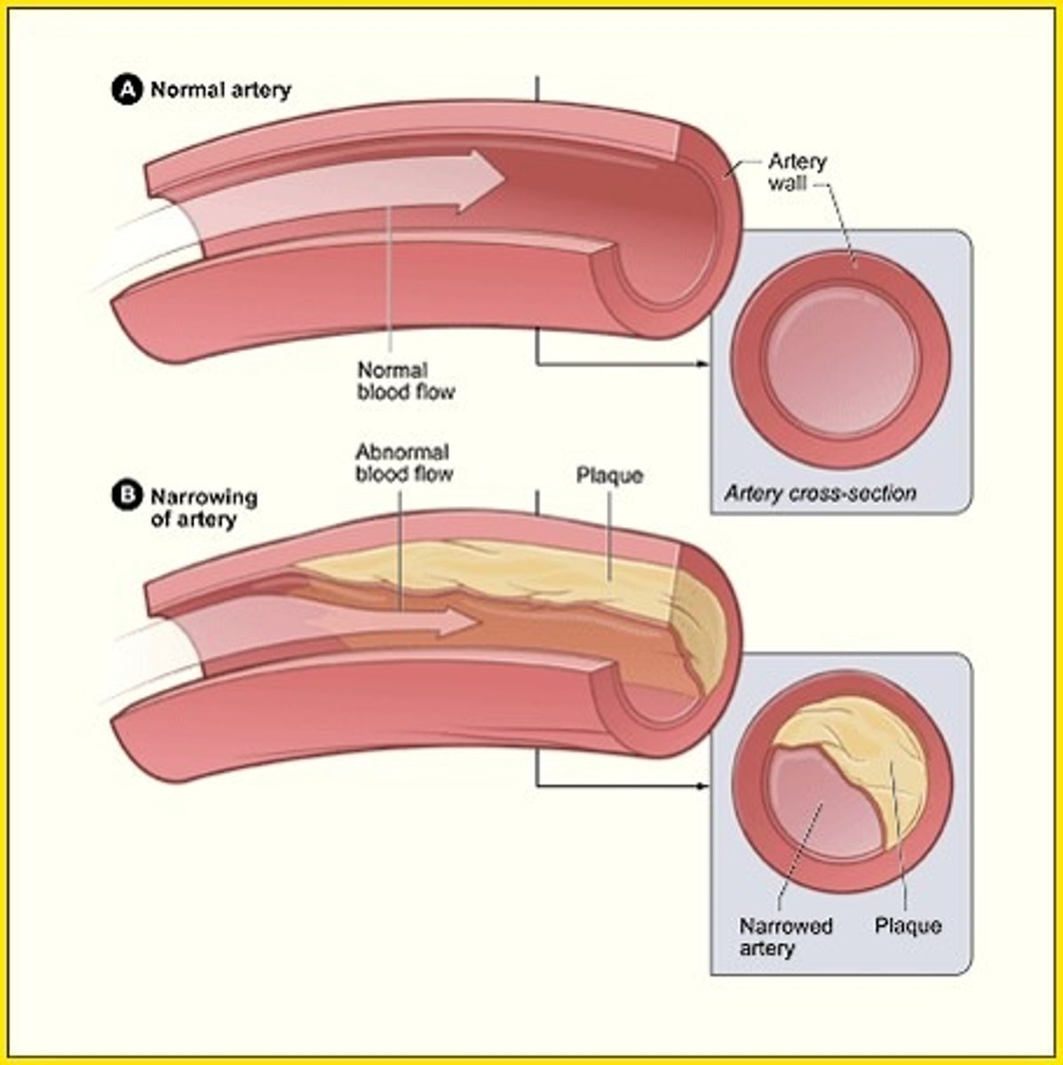 <p>artery that nourishes the heart muscle becomes thickened</p>