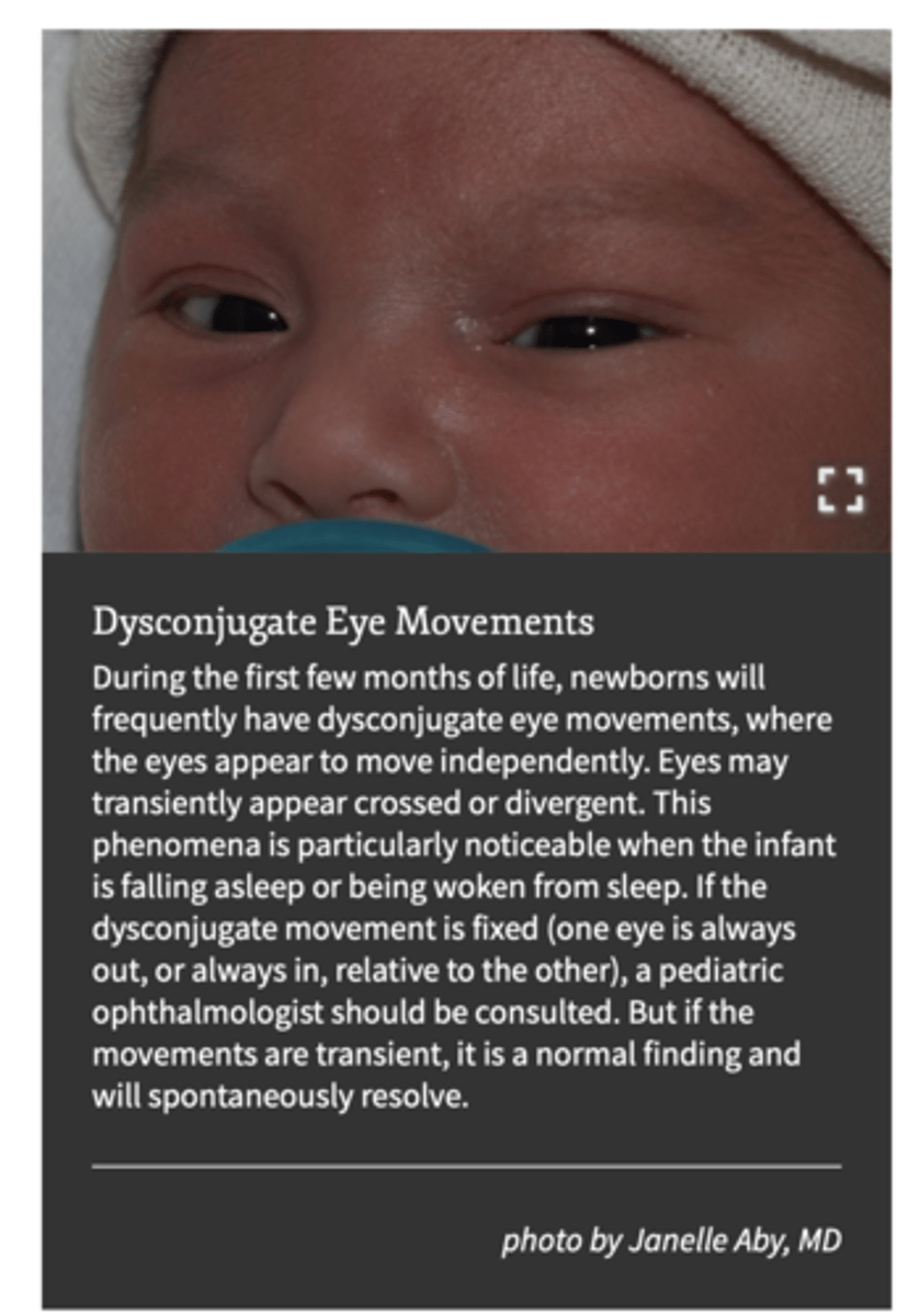 <p>is a misalignment of the eyes resulting in the inability of the eyes to focus on an object simultaneously. Although each eye can focus on an object individually, if strabismus is uncorrected, amblyopia (see definition later) may develop. Strabismus can be caused by weakness or paralysis of any of the six extraocular muscles, increase in intraocular pressure, or damage to cranial nerves. Strabismus may be horizontal (esotropia or exotropia), vertical (hypertropia or hypotropia), or torsional depending on which extraocular muscles and nerves are involved</p>