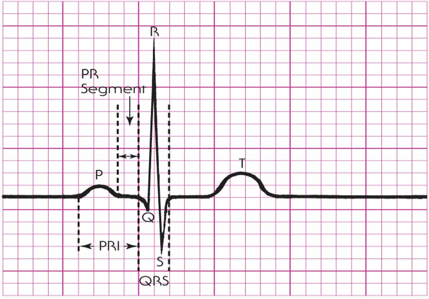 <ol><li><p><strong>Regularity </strong></p><ul><li><p>Are the R-R interval evenly spaced? Is it regulat? </p></li></ul></li><li><p><strong>Rate </strong></p><ul><li><p>What is the HR?</p></li><li><p><span style="color: green;"><strong>Bradycardia: &lt;60bpm</strong></span></p></li><li><p><span style="color: green;"><strong>Tachycardia: &gt;100bpm</strong></span></p></li><li><p>Normal: 60-100</p></li></ul></li><li><p><strong>P Waves </strong></p><ul><li><p>Are P waves present?</p></li><li><p>Upright?</p></li><li><p>One for every QRS?</p></li></ul></li><li><p><strong>PR Internval </strong></p><ul><li><p>What is the PR interval </p></li><li><p><span style="color: green;"><strong>Normal: 0.12-0.20s </strong></span></p></li></ul></li><li><p><strong>QRS Complex</strong></p><ul><li><p>Is it narrow or wide </p></li><li><p><span style="color: green;"><strong>Normal: &lt;0.11s </strong></span></p></li></ul></li></ol><p></p>