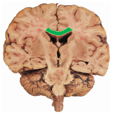 <p>What is this bridge that connects the two hemispheres of the cerebrum?</p>