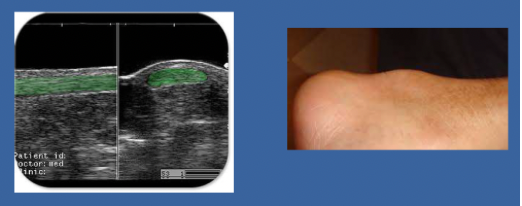 <p>no (they look stiff due to bump but stiff tendons are good to dissipate force, tendinopathy tendons are less stiff and less able to handle force) </p>