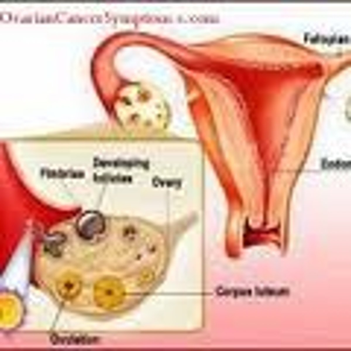 <p>cancerous tumor formed within ovary</p>