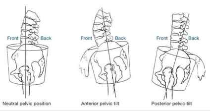 <p>▸ Posterior pelvic tilt</p>