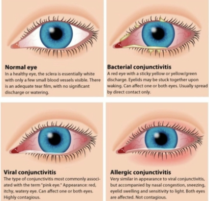 <p>needs to be differentiated serologically from H. influenzae. causes conjunctivitis (pink eye), which can be epidemic in kids. treated with local administration of ophthalmic antibiotic solution</p>