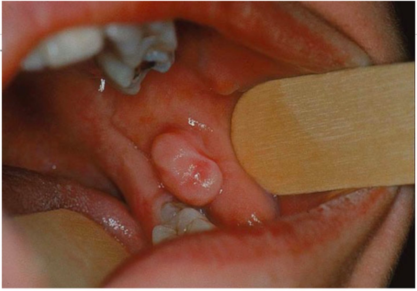 <p>-attached by a stemlike or stalklike base</p>
