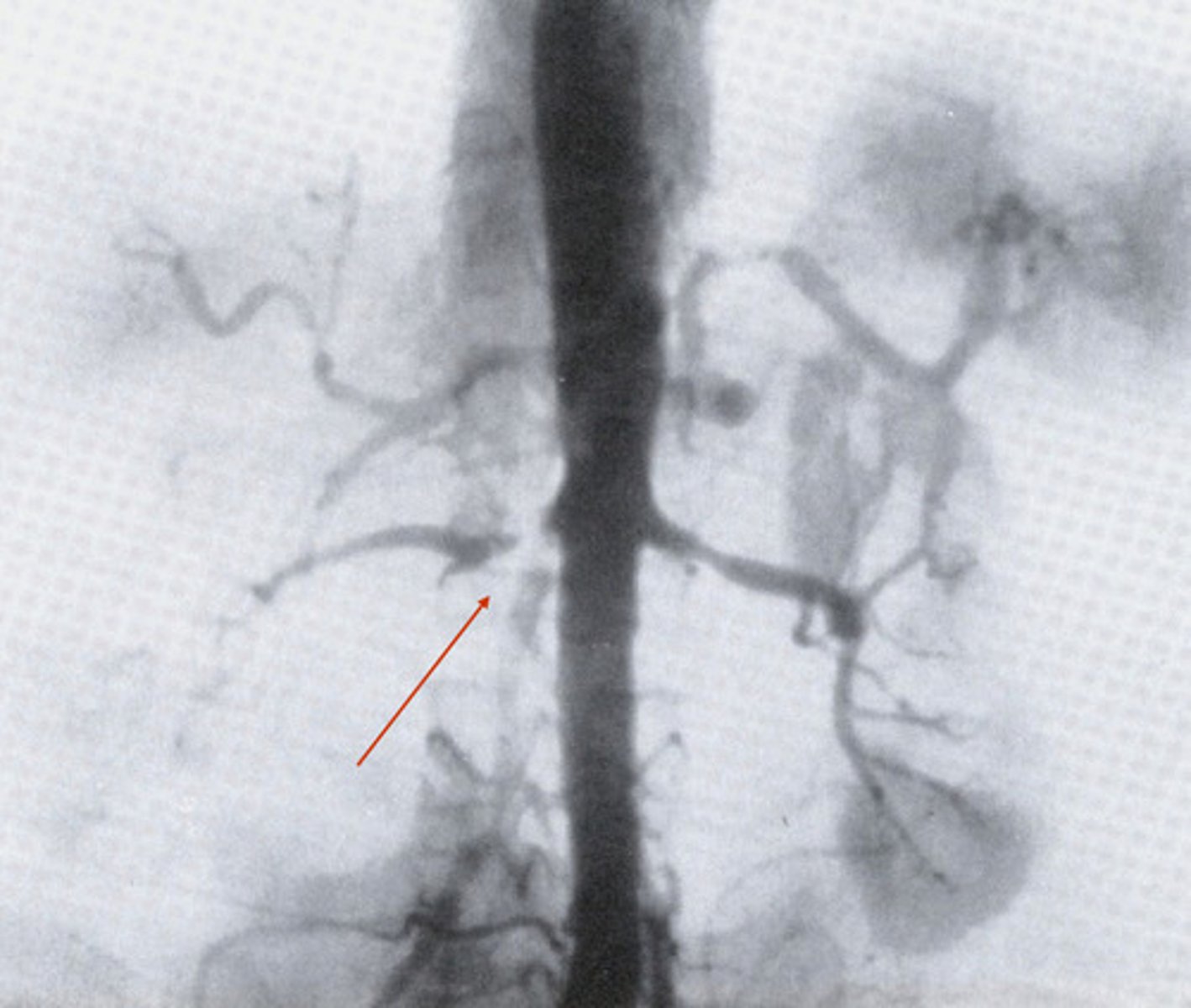 <p>What can be caused by stenosis (narrowing) in the renal arteries?</p>